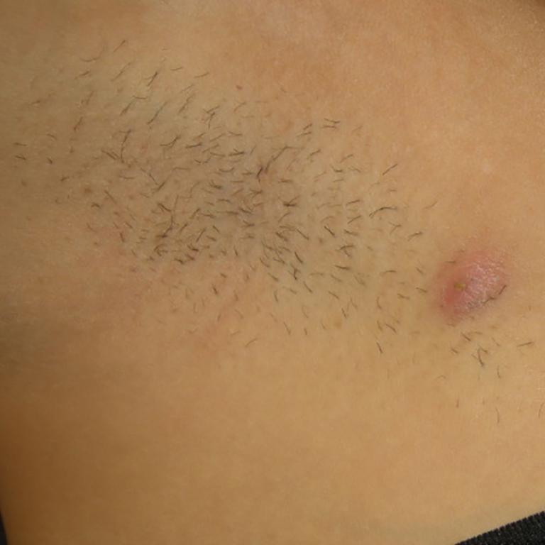 Hidradenitis suppurativa in the armpit across Hurley stages - Stage 1
