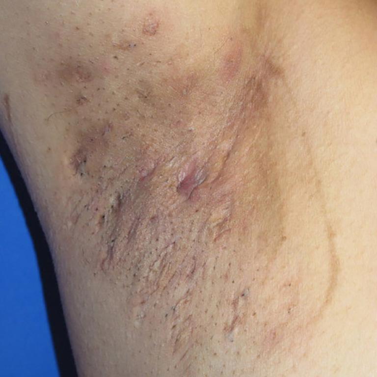 Hidradenitis suppurativa in the armpit across Hurley stages - Stage 2