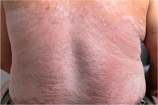 Erythrodermic Psoriasis