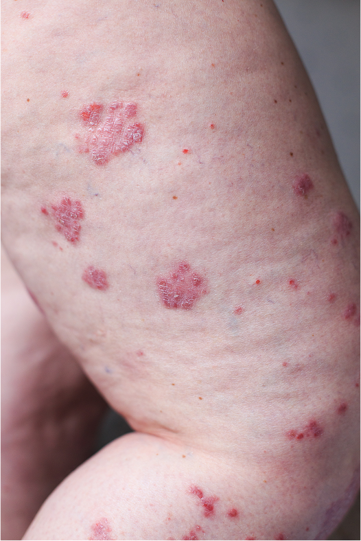 Guttate Psoriasis