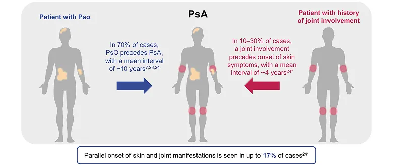 Most patients present with psoriasis before PsA