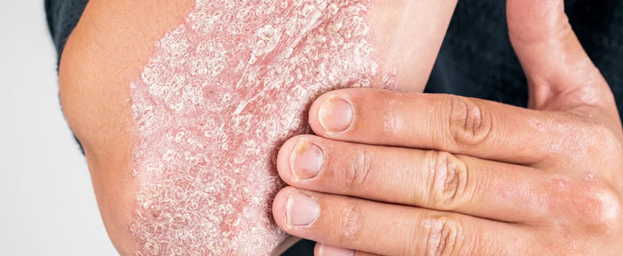 Understanding psoriasis