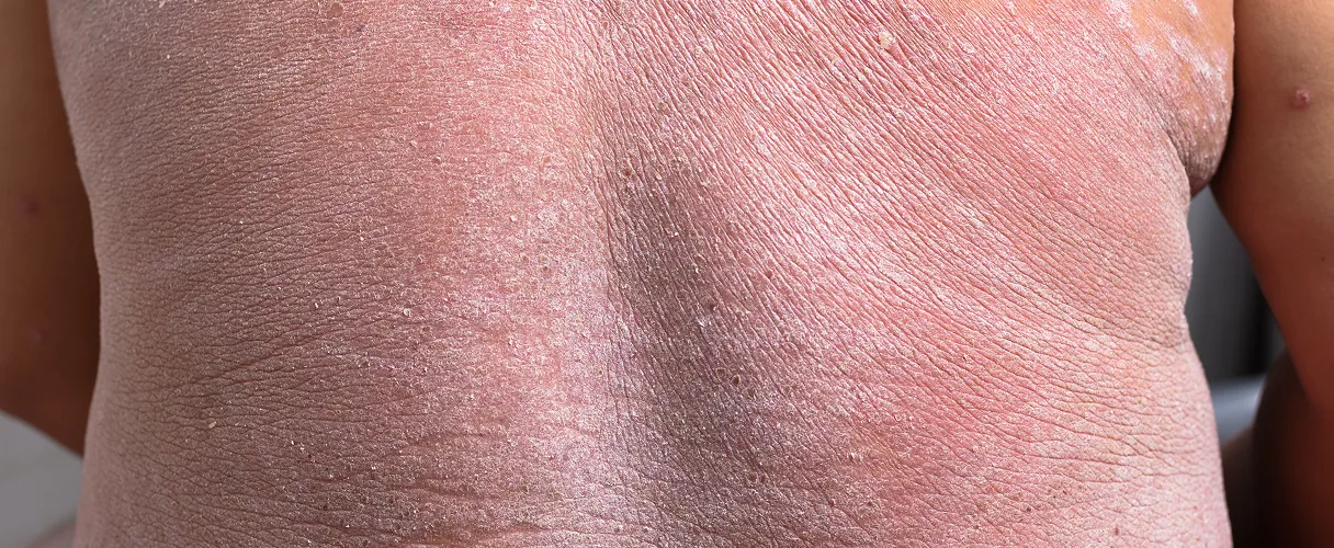 Quality of life with psoriasis