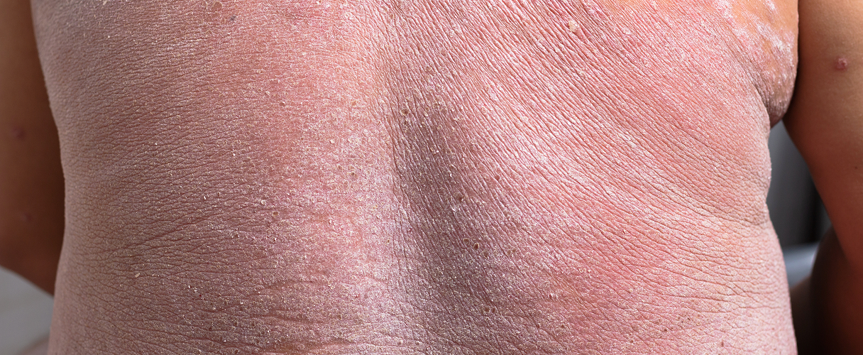 Quality of life with psoriasis