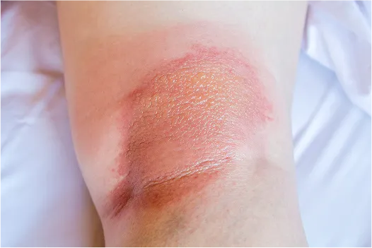 Inverse psoriasis