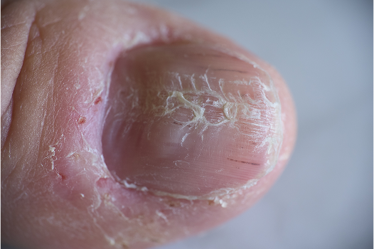 Nail Psoriasis