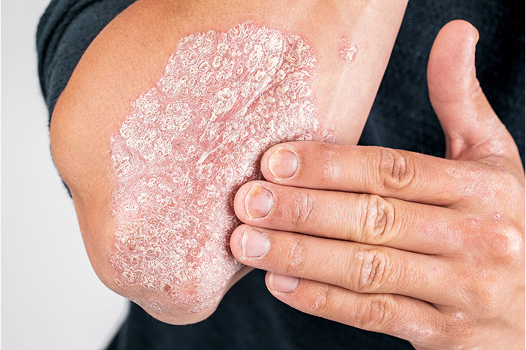 Plaque Psoriasis