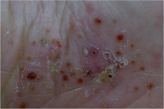 Psoriasis pustulosa